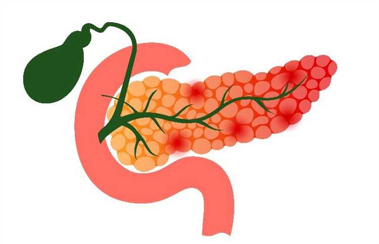 Какие формы хронического панкреатита влияют на категорию годности