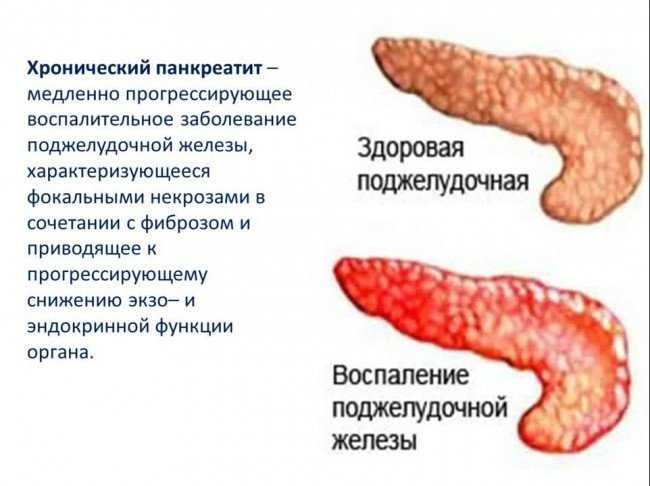Психологические аспекты и стрессовые факторы при хроническом панкреатите