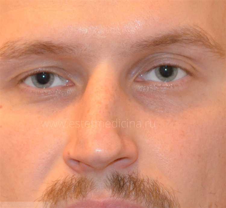 Сроки давности и особенности возбуждения дела по факту перелома носа