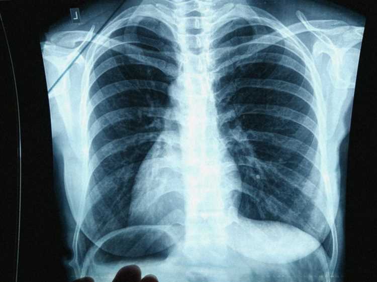 Какие особенности флюорографии для разных категорий медперсонала?