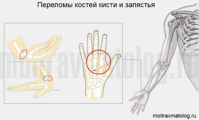 Юридическая классификация степени тяжести вреда при переломе руки